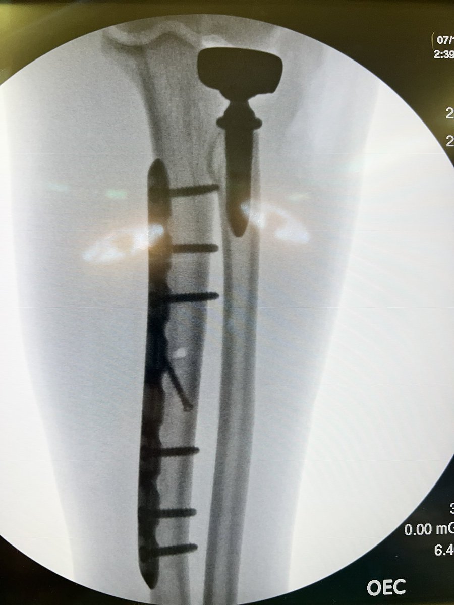 Why Hand Surgery is the best. My week included;
Monteggia Variant
Poland Hand syndactyly
Spaghetti wrist with median nerve micro <a href="/UTHealthSAOrtho/">UT Health San Antonio Orthopaedic Residency</a> #orthotwitter