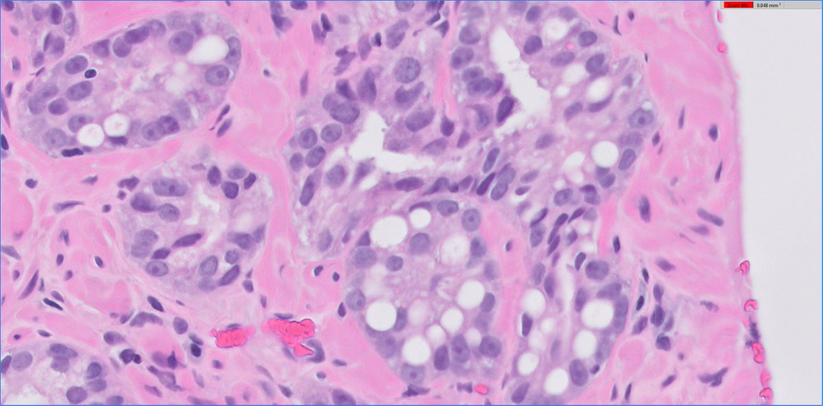 slusagar's tweet photo. #GUpath prostate bx:
all that is "signet-ring" is not Gleason pattern 4/5!
similar to mucin, rule is to subtract it off and grade the underlying architecture

🔬3+3 PCA (showing "signet ring cell like" change) https://t.co/4022IXMJgf