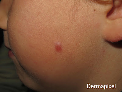 SCPed's tweet photo. 🔍"Un grano que no se va", cas de dermatologia pediàtrica al blog #Dermapixel de @rosataberner https://t.co/xR8v3JyR8H https://t.co/XeGvUfWo4w