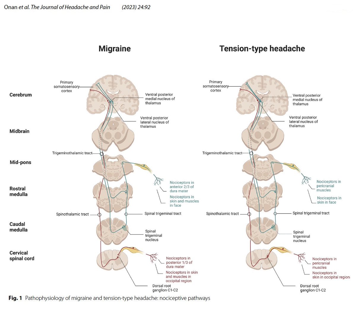SaitAshina's tweet photo. Trigeminal nociceptive system facilitates pain perception by transmitting signals from pain-sensitive structures in head/neck via neurons in trigeminal ganglion, through brainstem and thalamus, to cortex, is integral to tension-type #headache and #migraine https://t.co/MIncVwFOKq https://t.co/b5l9c41pwJ