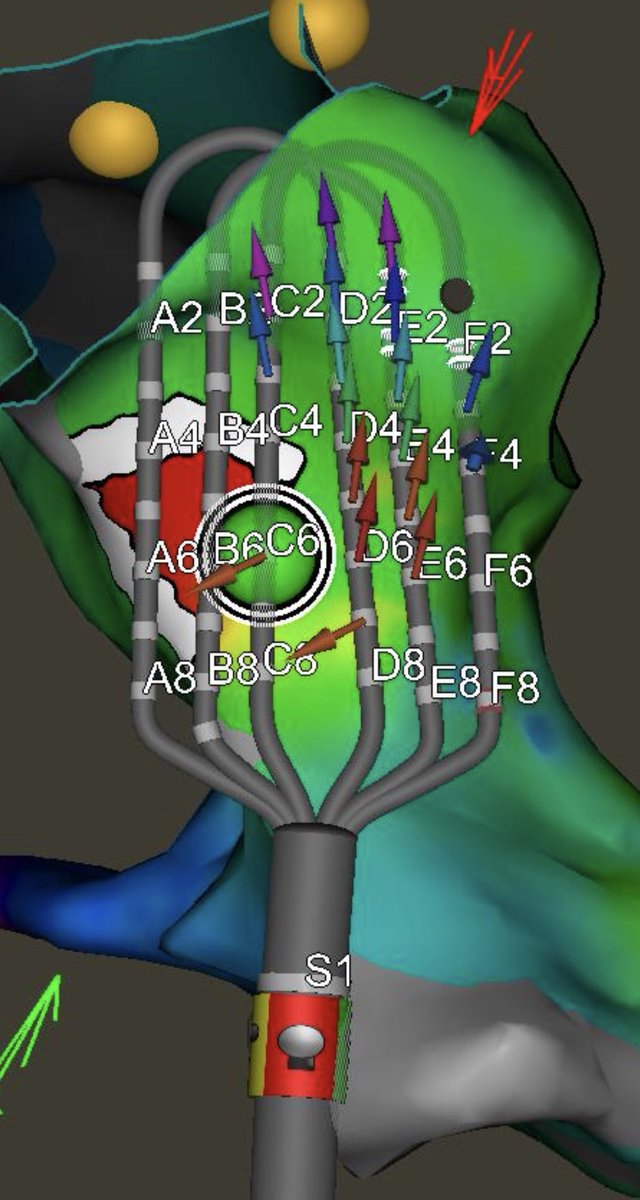 Megna Saha (@megna_saha) on Twitter photo Successful launch day at @SIUHhospital of the #Optrell mapping catheter. Grey Discs on isolated posterior wall for a Persistent Afib then next case showed power of Real time LCVs during focal activity in an AT! Thanks to <a href="/ValayParikhMD/">Valay Parikh</a> !
#EPeeps <a href="/NorthwellHealth/">Northwell Health</a> Successful launch day at @SIUHhospital of the #Optrell mapping catheter. Grey Discs on isolated posterior wall for a Persistent Afib then next case showed power of Real time LCVs during focal activity in an AT! Thanks to <a href="/ValayParikhMD/">Valay Parikh</a> !
#EPeeps <a href="/NorthwellHealth/">Northwell Health</a>