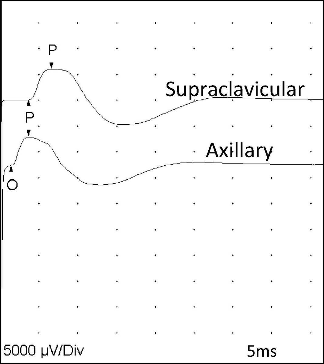 ClinicalNeuroph's tweet photo. [Long thoracic nerve conduction velocity] Galloway et al. described a new technique to record long thoracic nerve conduction velocity through the axilla.  

https://t.co/bI3dQfQbMg
@BelmontUniv
#NerveConduction #ClinicalNeuroph https://t.co/CMdaLMWkhi