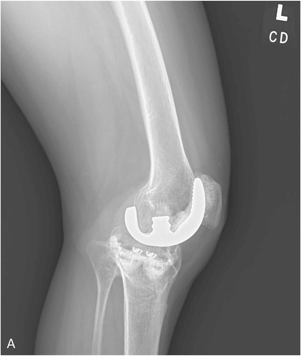jbjs's tweet image. Case Report of Successful Bilateral Total Knee Arthroplasty

tinyurl.com/yw8pfjay