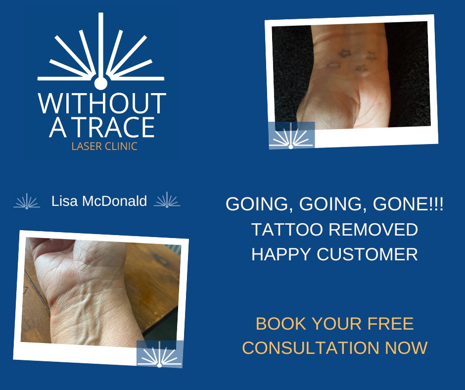 **Say goodbye to your unwanted tattoo with laser tattoo removal. Book your free consultation today!**

#lasertattooremoval #tattooremoval #freeconsultation