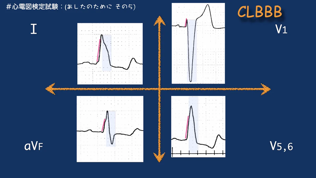 N. Tsukishima EP大学心電図検定学部試験対策科担任 on X: 