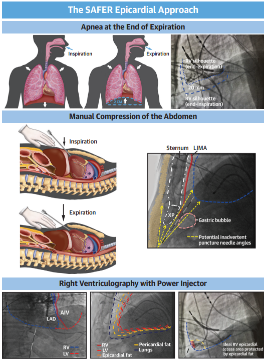 William H. Sauer, MD (@true_ep) on Twitter photo Can we improve upon epicardial access? <a href="/JorgeERomeroMD/">Jorge E. Romero, MD, FACC, FHRS</a> has pioneered an approach using end expiration apnea, imaging with right ventriculography, and abdominal compression to obtain outstanding results.
authors.elsevier.com/a/1hSVc,siTgg-… Can we improve upon epicardial access? <a href="/JorgeERomeroMD/">Jorge E. Romero, MD, FACC, FHRS</a> has pioneered an approach using end expiration apnea, imaging with right ventriculography, and abdominal compression to obtain outstanding results.
authors.elsevier.com/a/1hSVc,siTgg-…