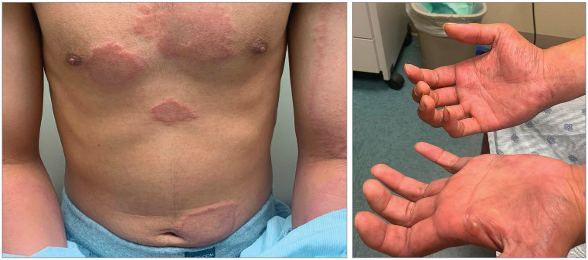 A previously healthy individual presented to a derm clinic for evaluation of annular skin lesions that appeared first on his right ankle and then on other areas of his body over a 3-month period. Take the Clinical Challenge. What would you do next? ja.ma/3DnJD9F