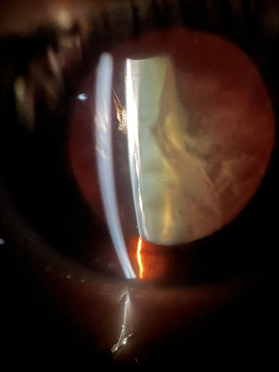 A beautiful cataract