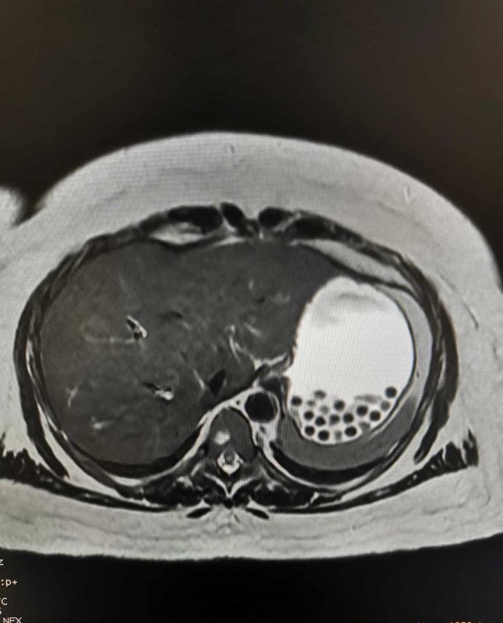 Another case of boba tea ingestion 🧋 on mri!