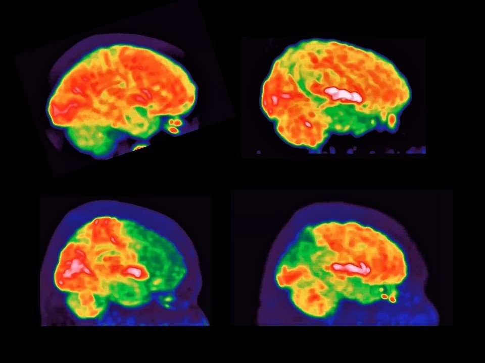 #WorldBrainDay!
I would like to share 4 images of the brain, which were obtained by means of molecular imaging (18F-FDG PET/CT) in a healthy subject, and patients with amnesic #AlzheimersDisease , #FrontotemporalDementia, and Posterior Cortical Atrophy
#Neuropsychiatry #Neurology