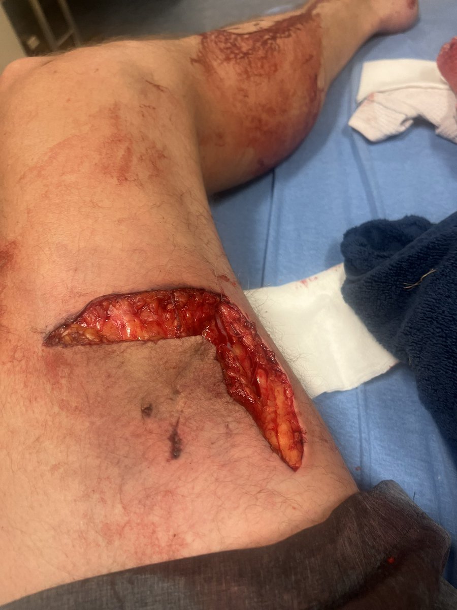 CDiebling's tweet photo. @CasualtyWar @e_cdalton @bluethroughline Lol the owner of the husky that did this to me 6 days ago said the same thing to me.  Keep your dog on a goddamn leash. https://t.co/wmfoc2fFdl