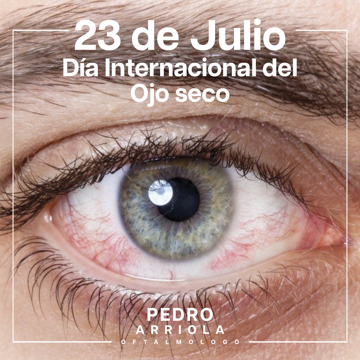 #diamundial #diamundialdelojoseco #ojoseco #cornea #salud #saludocular #oftalmologo #oftalmologia #ophthalmologist #ocularsurface #dr #doctor