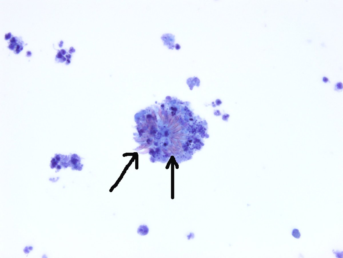 One of the best cases from my cytopathology fellowship many years ago. An FNA from a hydatid cyst. One of the most stunning I have ever seen! #Echinococcus