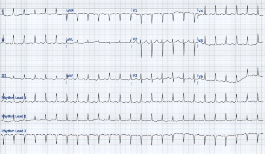 This is a case of a 62 yo female who comes to the ER due to progressive dyspnea and edema. She says her heart feels accelerated since a year or so.. thoughts on the rhythm?