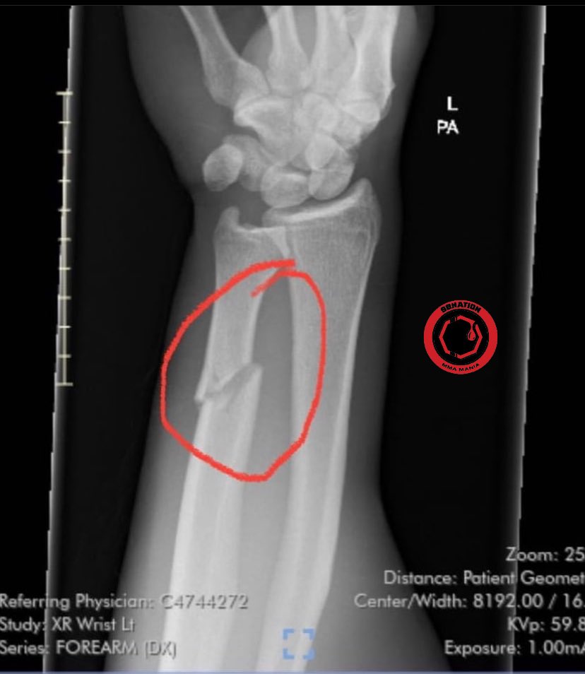 RT @mmamania: Yanal Ashmouz broke his wrist in the first round of his fight against Chris Duncan https://t.co/KoamGpnX3X