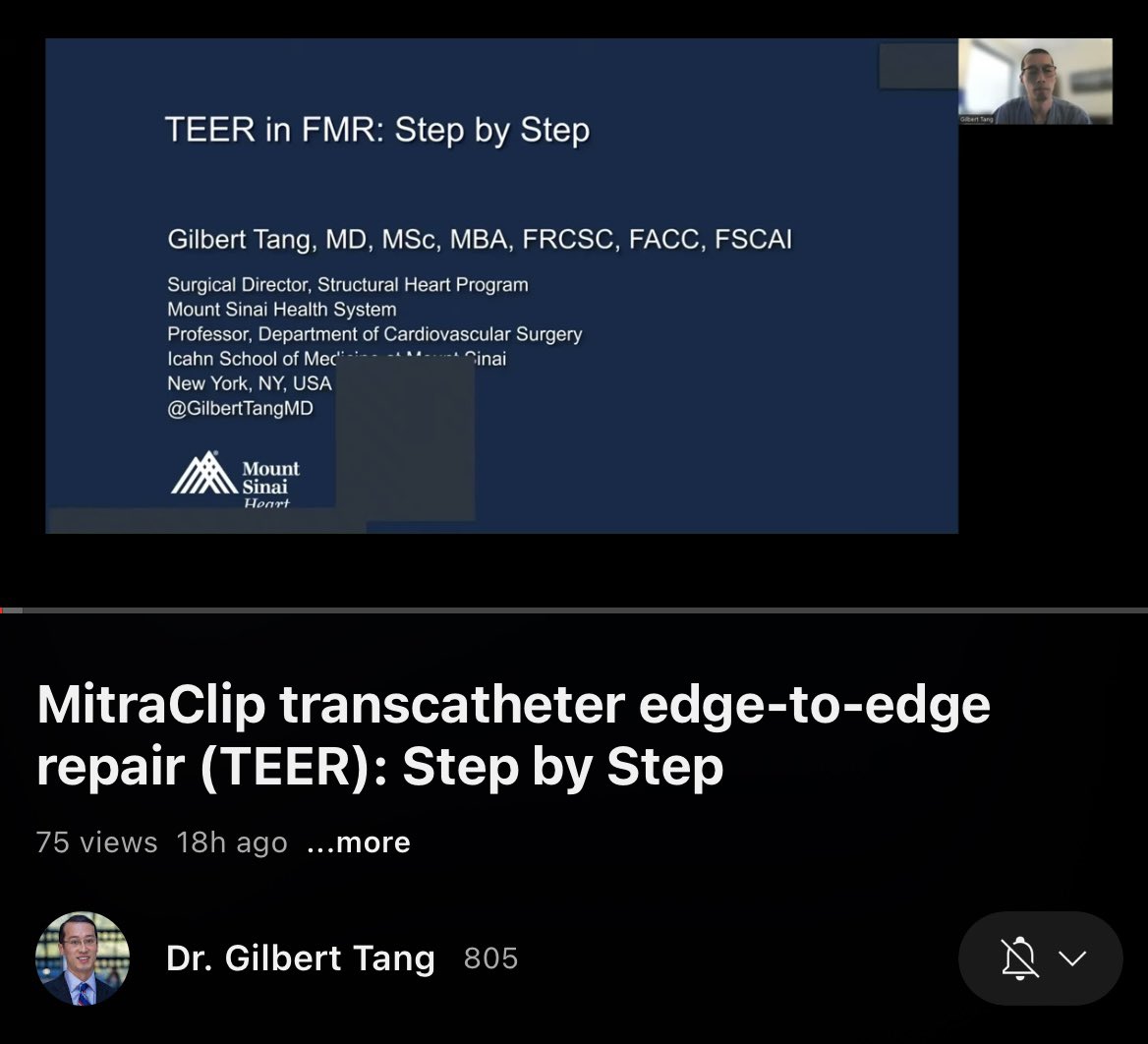 Watch my @YouTube lecture #CHIPIndia2023 on @MountSinaiHeart M-TEER #Mitraclip TEE screening & Echo-Fluoro guided 10 min SMR XTW case. Reproducible across anatomies and east to train ❤️teams to do this! youtu.be/1e5oG2mrdDw @DoctorKini @LucySafi @KHERA_MD @ParasuramMD