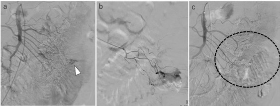 #SundayRead

Where endoscopic approaches are impossible or ineffective, transcatheter arterial embolization is a standard for #LGIB

With several embolic materials available, how do you choose? 

Here, imipenem/cilastatin is evaluated:
cvirendovasc.springeropen.com/articles/10.11…