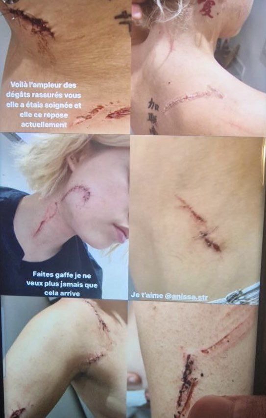 French teen girl left disfigured after being viciously attacked by a North African gang with broken glass for wearing ‘immoral’ crop top on night out in Toulouse.
This is the future for all western women if the invasion continues 😡😡