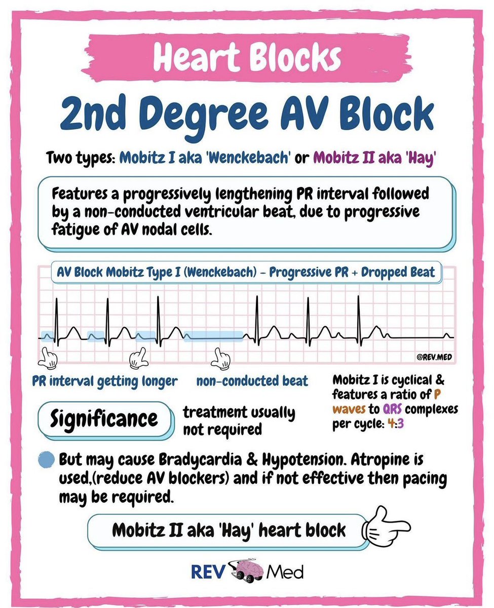 Cardio made super simple!🫀 

Types of Heart Blocks with ECGs

📌Save it, swipe it, &amp; begin learning!

#FOAMed #MedEd #CardioEd #CardioTwitter #MedTwitter #livertwitter #Cardiology #livertwitter #4KMedEd #ECG #medicalstudent 
#MedicalEducation #Emergency #medicalpractice