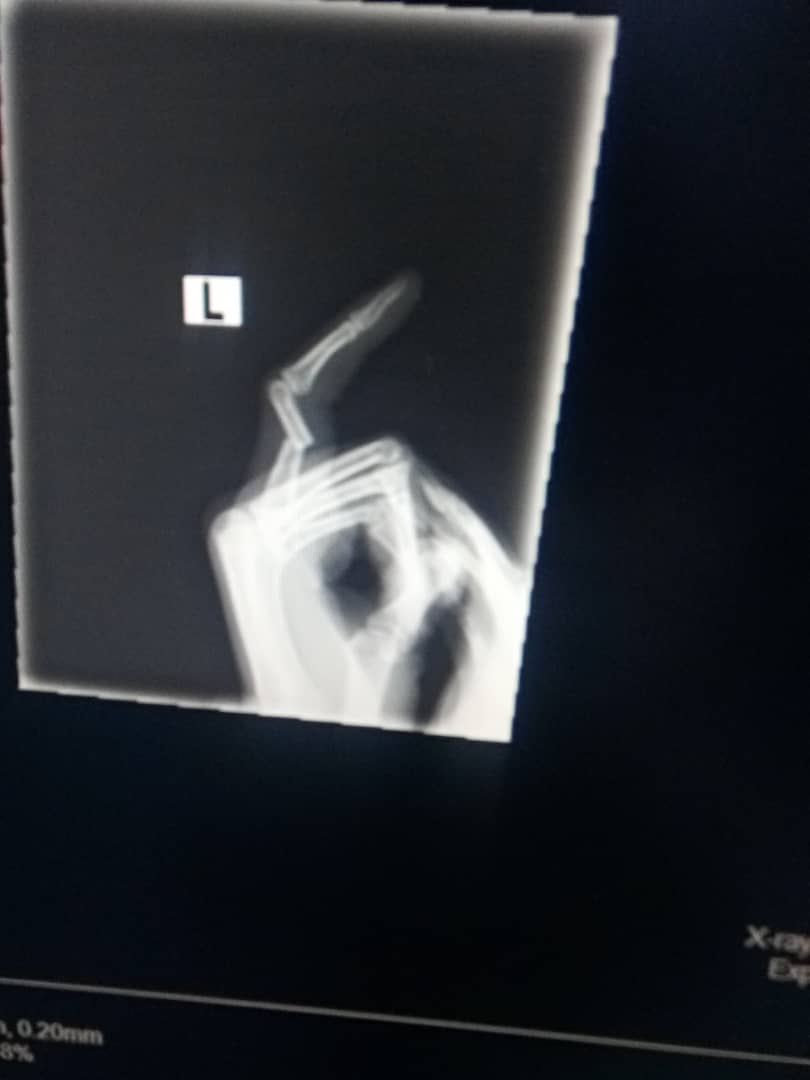 TSS05•07•2022💔VALHALLA🕊 on Twitter "Anytime I take off my finger splint, I'm thankful for the