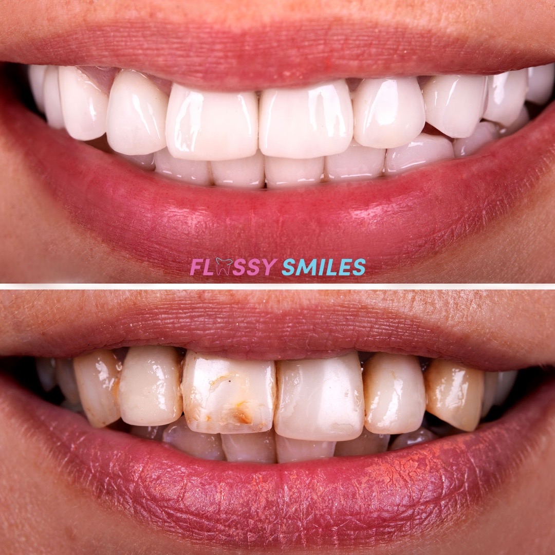 Before & After #compositeveneers. Prices starting at only $3489!. Book your appointment today.

#veneers #carillas