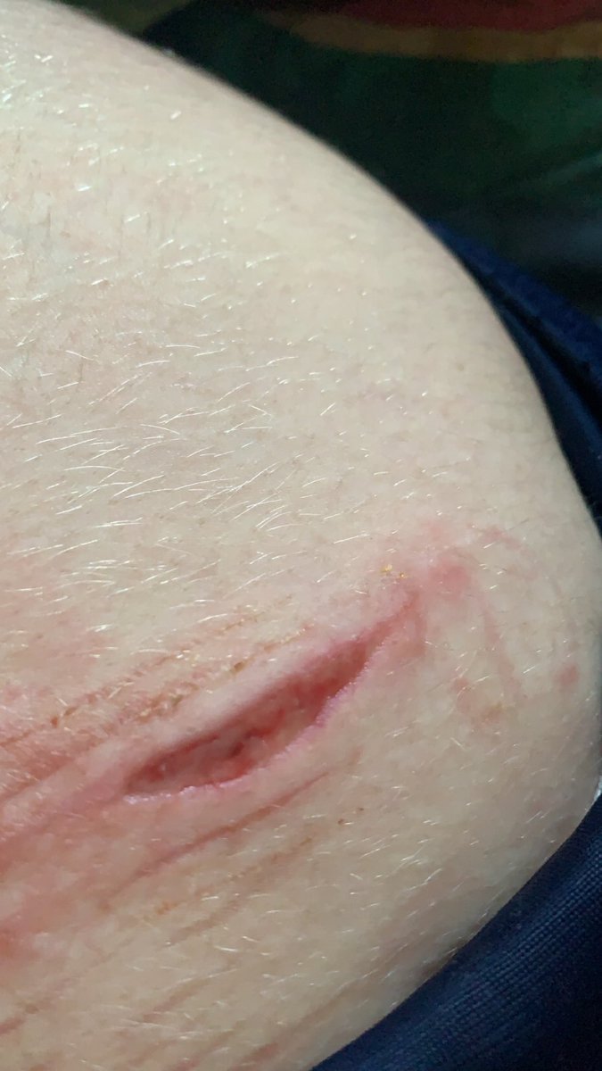 sillyoasis's tweet photo. || ALL FAKE JUST SFX MAKEUP || 

Guys, I need to know if it’s infected. I’m pretty sure the cut is alright, but I might have reacted to the bandage bcause my skin itches and it’s swollen 😨😨

.
.
.
.
.
.
.
.

Shtwt beanstwt styrotwt ouchietwt redinktwt 988twt https://t.co/HHDYUg6rjN