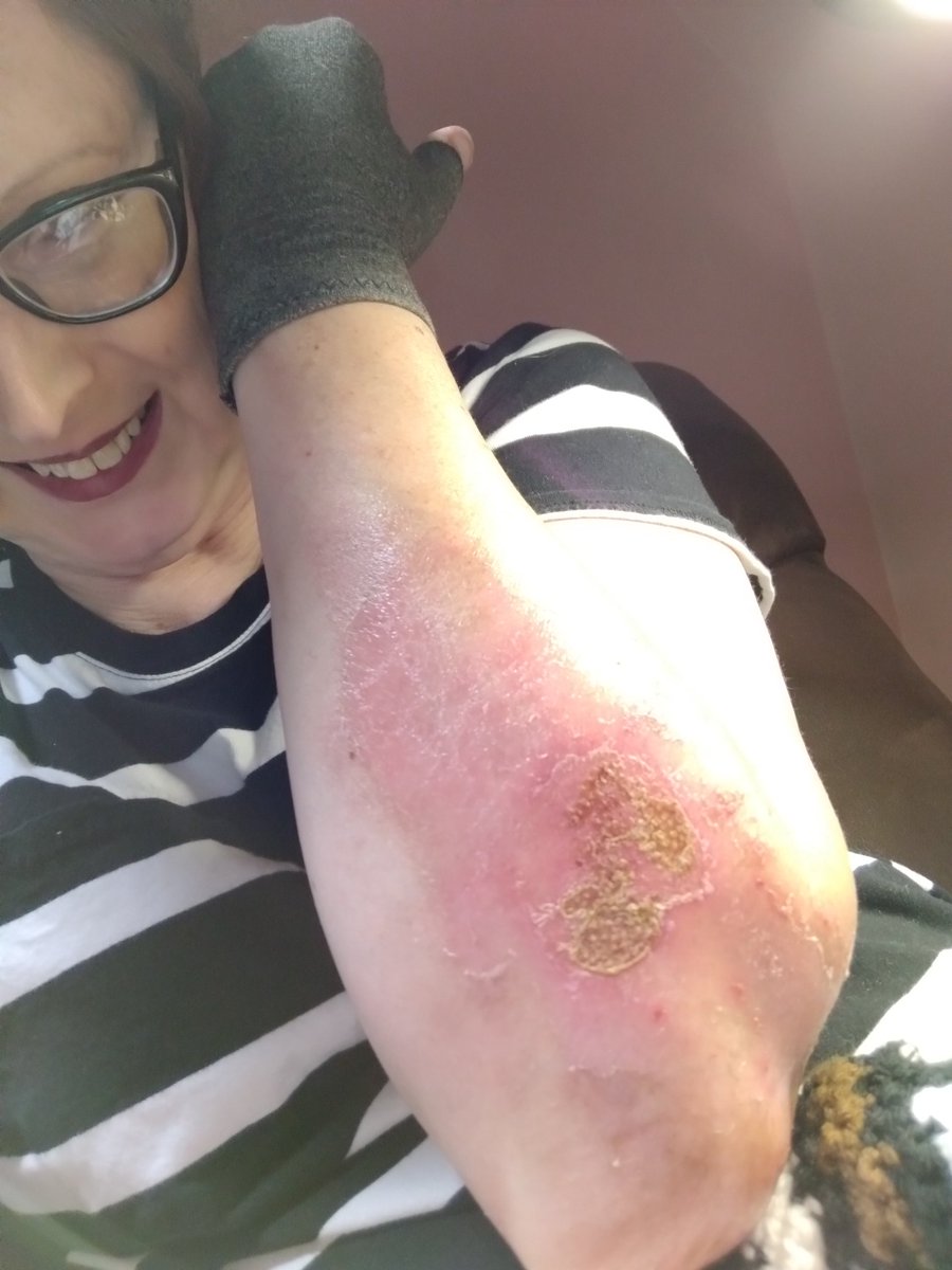 MsLizzyBeth1's tweet image. This is my arm healing up quite well from me casting fireball...
Again, I reiterate, lesson learned 
#gasfire #burn