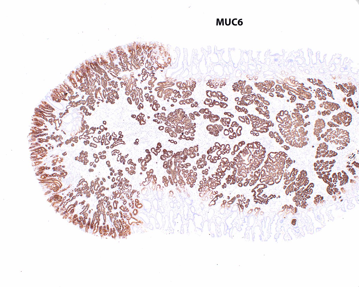 It is unusual to encounter pyloric gland adenomas in the gastric antrum in a background or reactive (chemical) gastropathy, but here is such a case. There is co-expression of MUC5 and MUC6 in the lesion, which shows high grade dysplasia. #UMiamiPath