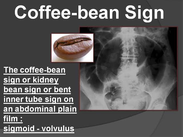Sigmoid Colon Volvulus Coffee Bean Sign