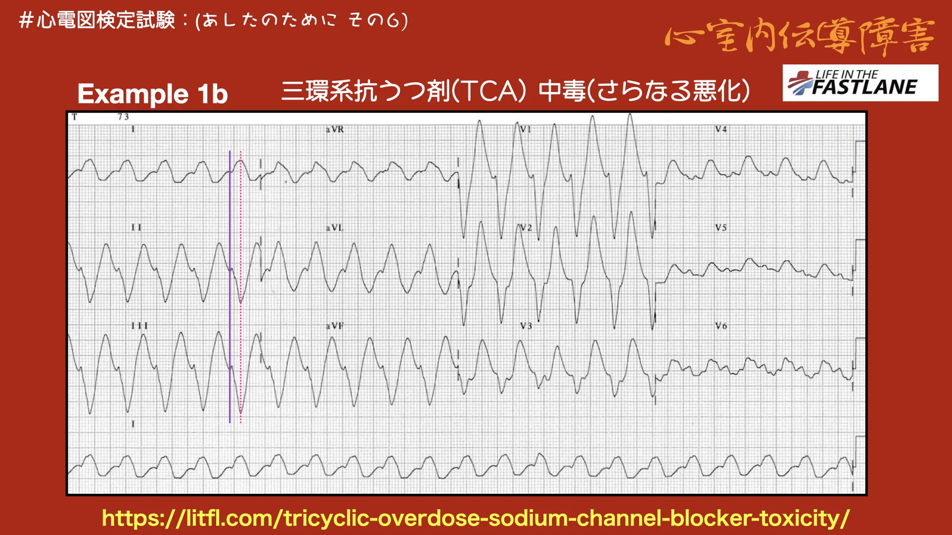 N. Tsukishima EP大学心電図検定学部試験対策科担任 on X: 