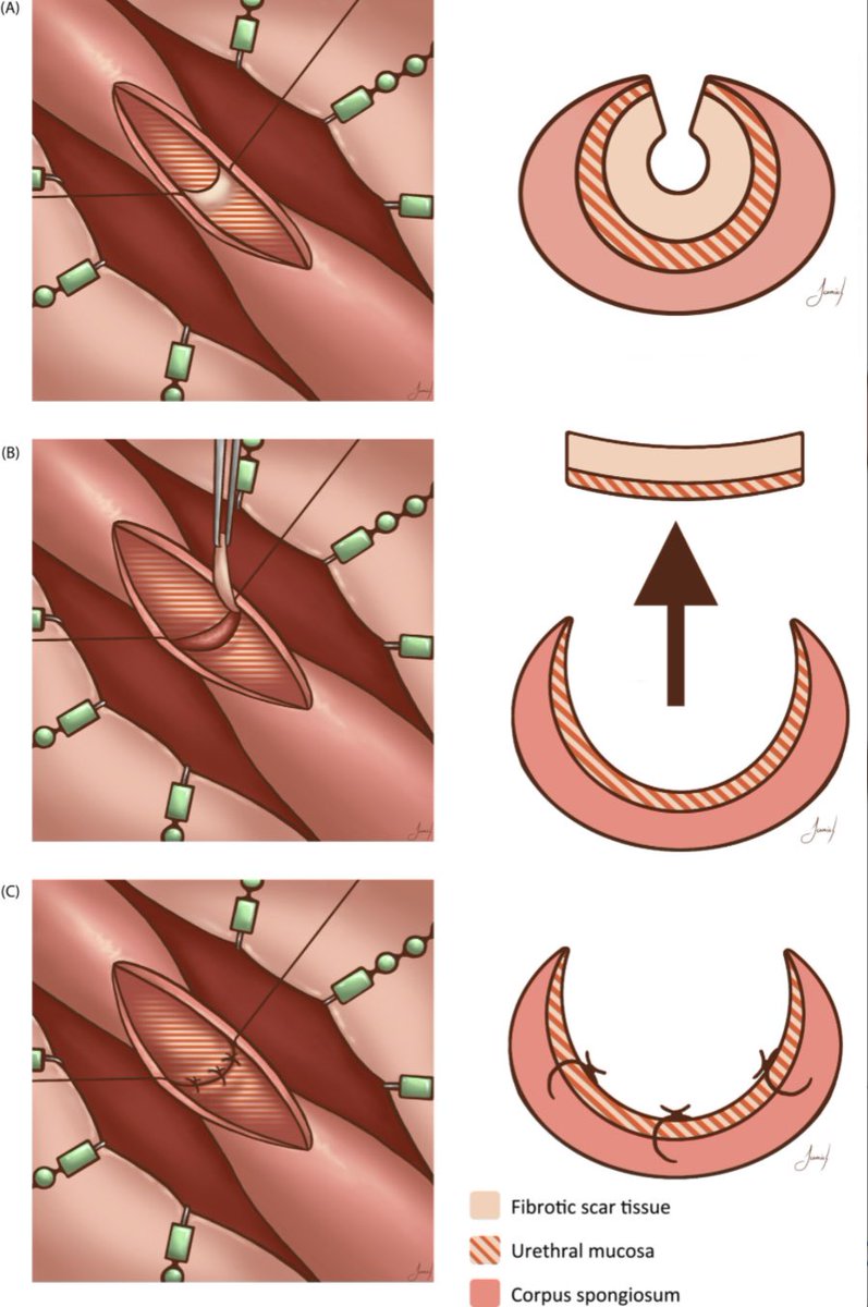 Delighted to finally share our MANTA urethroplasty, a ventral approach for short obliterative segments in longer bulbar strictures doi.org/10.1111/bju.16… <a href="/BJUIjournal/">BJU International</a> Phillip Marks <a href="/JakobFelin/">Jakob Klemm</a> <a href="/FredKoenig/">frederikkoenig</a> <a href="/DingLiucheng/">liucheng ding</a>, Florian Janisch <a href="/UKEHamburg/">UKE Hamburg</a>
