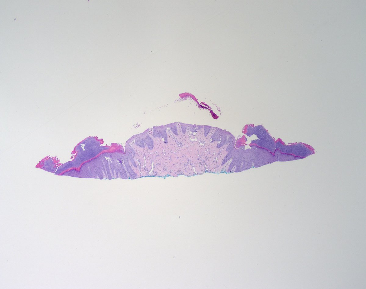 70s♂️index finger, RO SCC
Would you call this an angiofibroma? If yes, would it open up a can of worms... tuberous sclerosis?
#dermpath <a href="/mccalmo/">Tim McCalmont</a> <a href="/HENRYY_MD/">Henry YANG</a> <a href="/DiegoMoralesN/">Diego Morales, MD</a> <a href="/FrozenSections/">Anurag Sharma</a> <a href="/DrAldehyde/">Woo Cheal Cho, MD</a> <a href="/VHNguyenMD/">Van-Hung Nguyen MD 🇺🇦🌻</a> <a href="/PIorfino/">Dermpath_doc_trish</a> <a href="/ChristineJKoMD/">Christine J. Ko, MD</a> <a href="/et565/">Etan Marks, DO</a> <a href="/vincenzopolizz7/">vincenzopolizzi</a>  <a href="/JamesSampson123/">James Sampson</a>