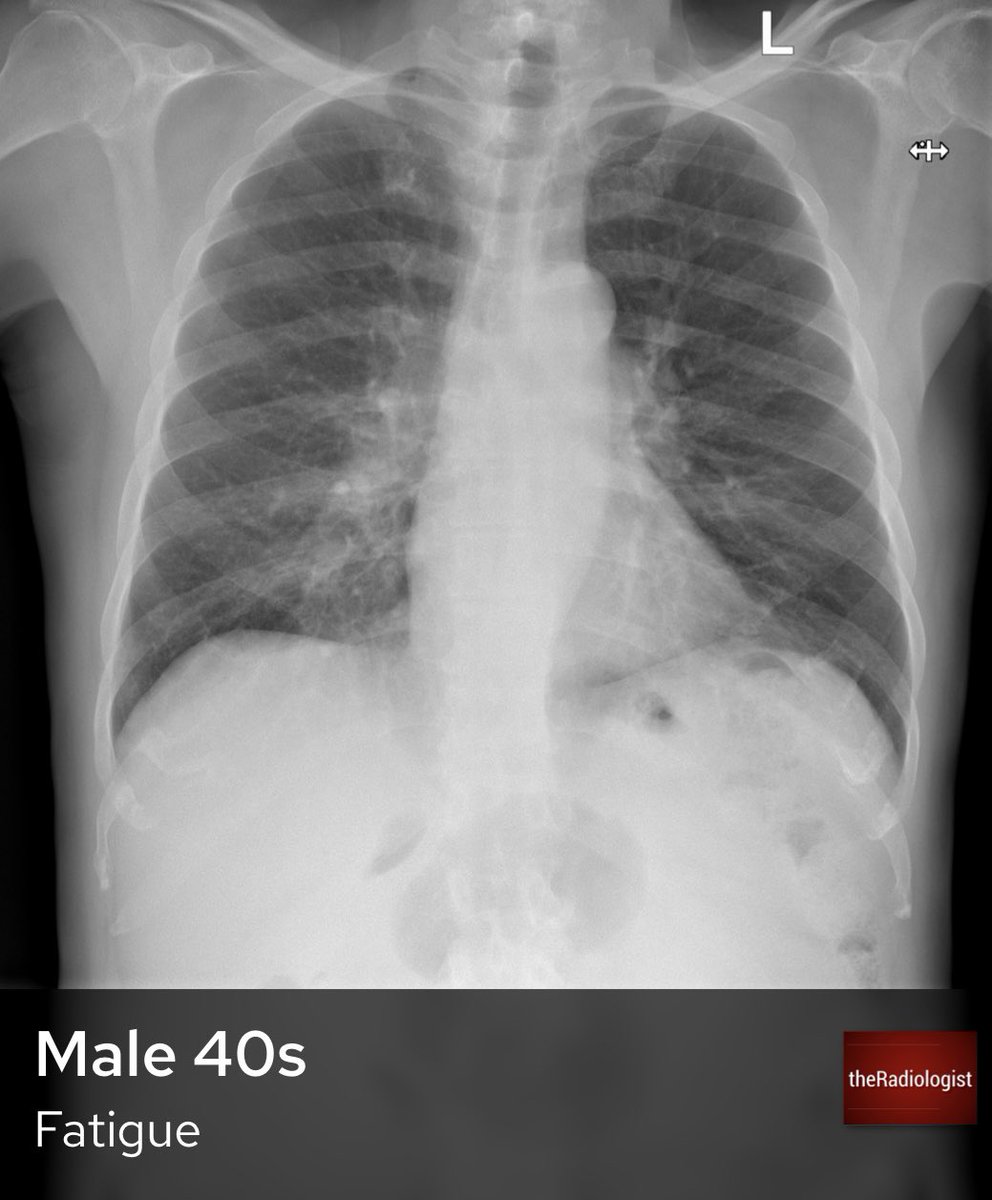 Chest Xray Normal Male