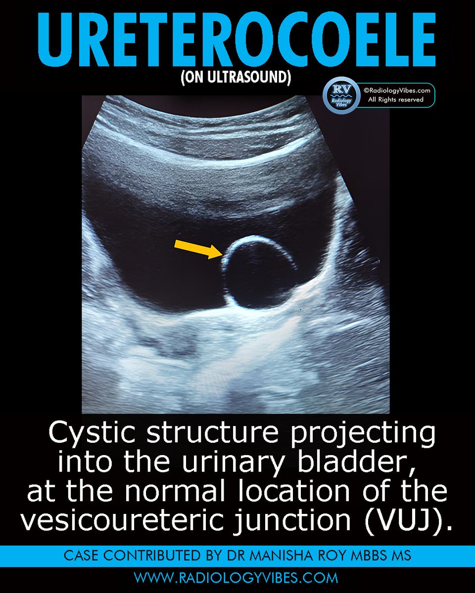 Ureteroceles are congenital dilatations of the distal ureter that can herniate into the bladder. 

Case contributed by Dr Manisha Roy MBBS MS 🩺💊💉

#radresidents #radres #radiology #FOAMrad