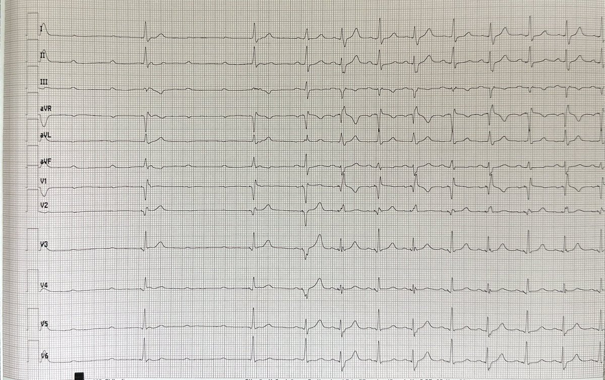 3 types of LBA capture complexes in post TAVR CHB. #EPeeps