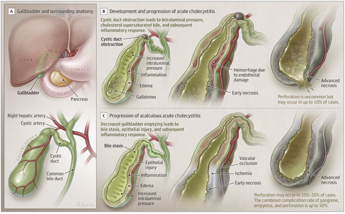 Andy Rekito won an Award of Merit for his illustration “Progression of Acute Cholecystitis” in the @JAMA_current clinical review from 3/8/22 “Acute Cholecystitis: A Review” by @_jrgallaher & @AnthCharMD jamanetwork.com/journals/jama/…