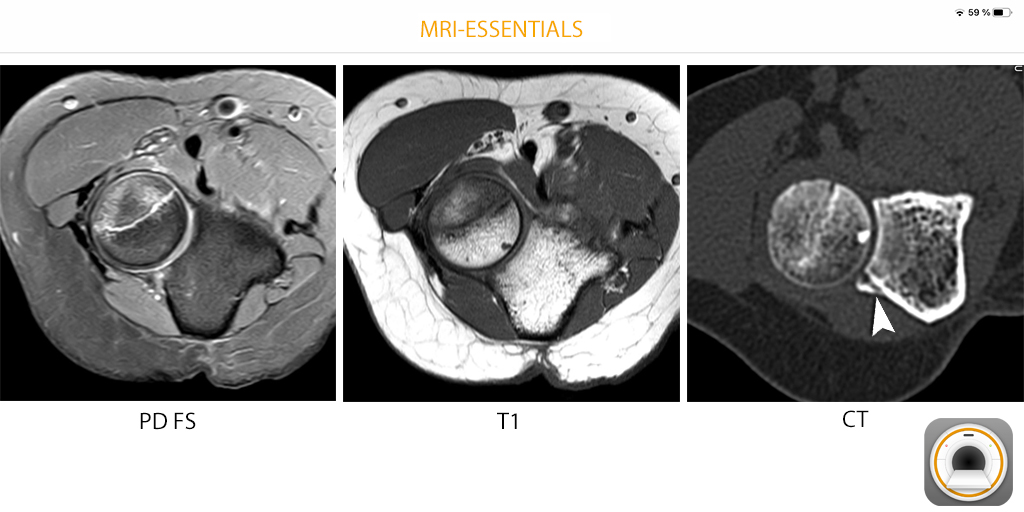 EssentialsMri's tweet photo. Obvious fracture of the radial head. The bony avulsion of the annular ligament was missed on MRI. The small fragment is clearly visible on CT (arrowhead).
#mskrad #orthotwitter #radres #radiology https://t.co/8G4w2jJTfI