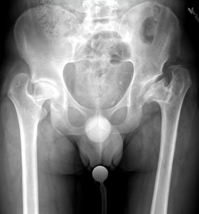 Looking forward to talking about hip arthroplasty in young patients this Wednesday. Register today! RJOS presents Hip Reconstruction: from Adolescence to Arthroplasty us02web.zoom.us/webinar/regist… @RJOSociety @rjosmedstudents @CeciPGarrido @AlisonDittmerMD
