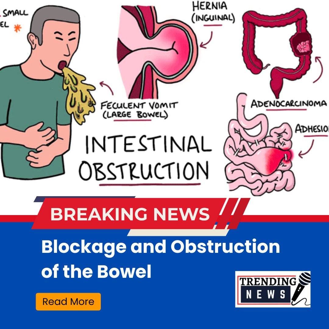 Blockage and Obstruction of the Bowel

thetrendingnews.xyz/2023/07/-Block…

#bowelobstruction,#smallbowelobstruction,#largebowelobstruction,#obstructionoftheintestine,#typesofbowelobstruction