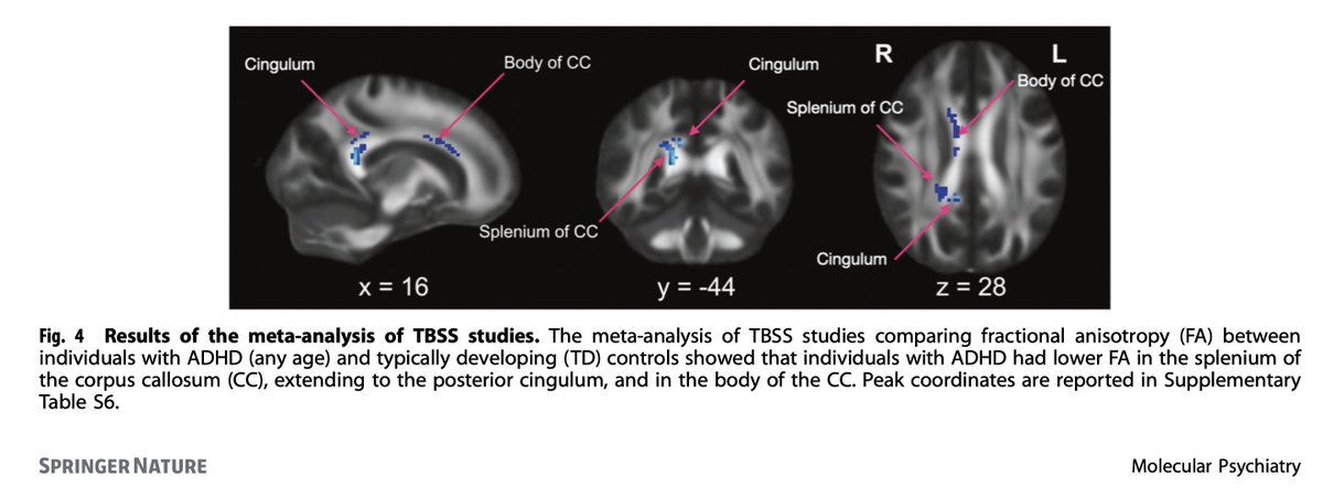 Big international team effort of collaborators, spearheaded by the talented Valeria Parlatini, investigated connectional alterations in #ADHD across 129 #diffusion imaging studies.

📝 Read the results: nature.com/articles/s4138…

@RegReports #ADHD #whitematter #tractography #TBSS