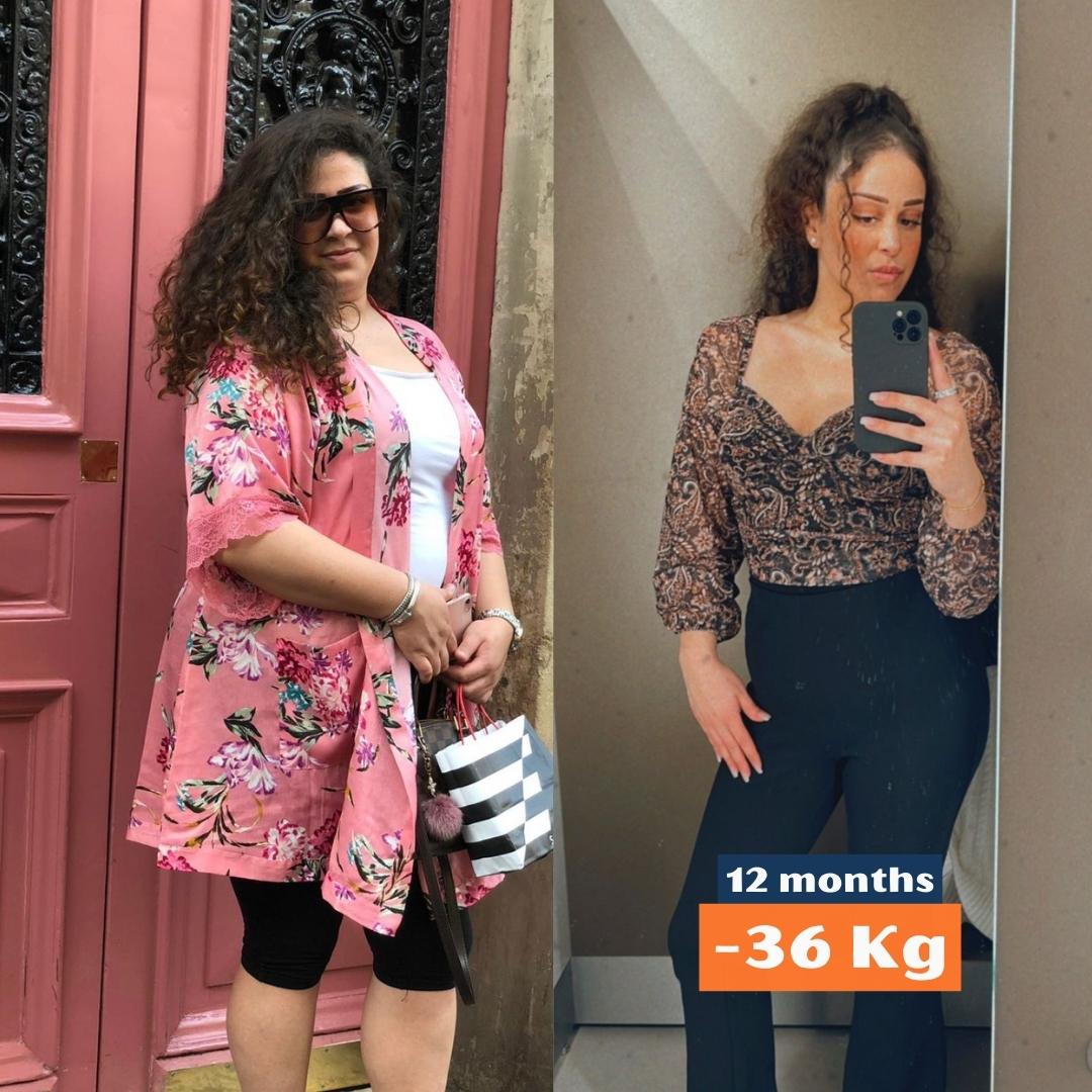 12 Months -36 kg🧿  

#tüpmide #mideküçültme #obesitysurgery #kiloverme #kilover #midebotoksu #gastricbotox #midebalonu #gastricballoon #revizyoncerrahisi