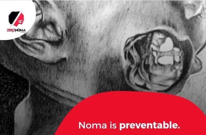 ZeronomaAfrica's tweet photo. The risk factors of #Noma are prevalent. Addressing them will prevent the occurence of this disease.

#Prevention
#zerocases
#Zeronoma https://t.co/qaTyYbucSQ