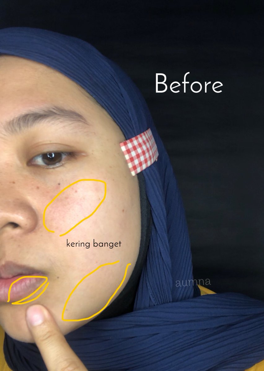 imymeaum's tweet photo. Punya kulit kering di tambah udara lagi dingin mulu tuh lumayan bikin stress ๐ฅฒ
Terus setelah searching, nemu juga nih metode CSM pake hydrating toner yang ternyata ngaruh banget bikin kulit lembab lagi ๐
#CSMmethod #racuninskincare #aumnareview https://t.co/LwMZYrMpaT