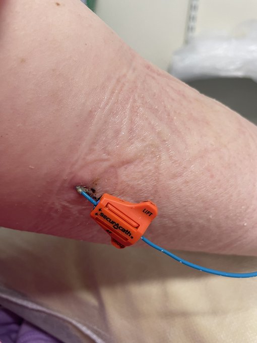 Having my PICC line cleaned before chemo!! 😣 https://t.co/3X2yFJCQjc<a href="/tag/findom"class="tags"><span>#findom</span></a><a href="/tag/cuckoldhubby"class="tags"><span>#cuckoldhubby</span></a><a href="/tag/onlyfansgirl"class="tags"><span>#onlyfansgirl</span></a><a href="/tag/alphadominant"class="tags"><span>#alphadominant</span></a>