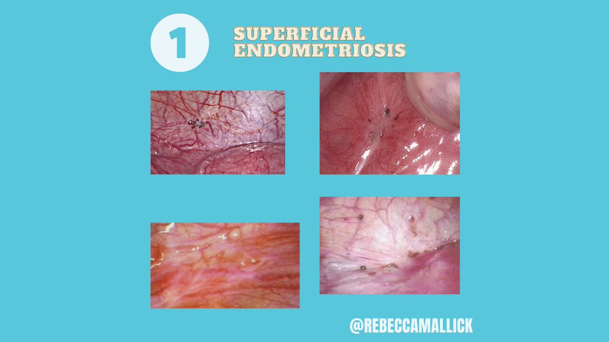 Asked quite a lot to discuss the different types of endometriosis - here is it!
👇👇
#askthegynaecologist
#endometriosis
