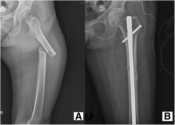 RheumAPP's tweet photo. Pooled analysis showed a significantly higher rate of delayed union in the TPTD (-) group than in the TPTD ( +) group:https://t.co/3cHCKrpCi4
#RhAPP #MetabolicMondays #osteoporosis #metabolicbonedisease #rheumatology #rheumtwitter https://t.co/eyBZBg4lhb