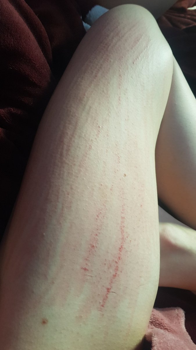 weedqueenalexis's tweet image. ouchies 👉🏻👈🏻

#scratches #scratchmarks #puppy #puppygf #kink