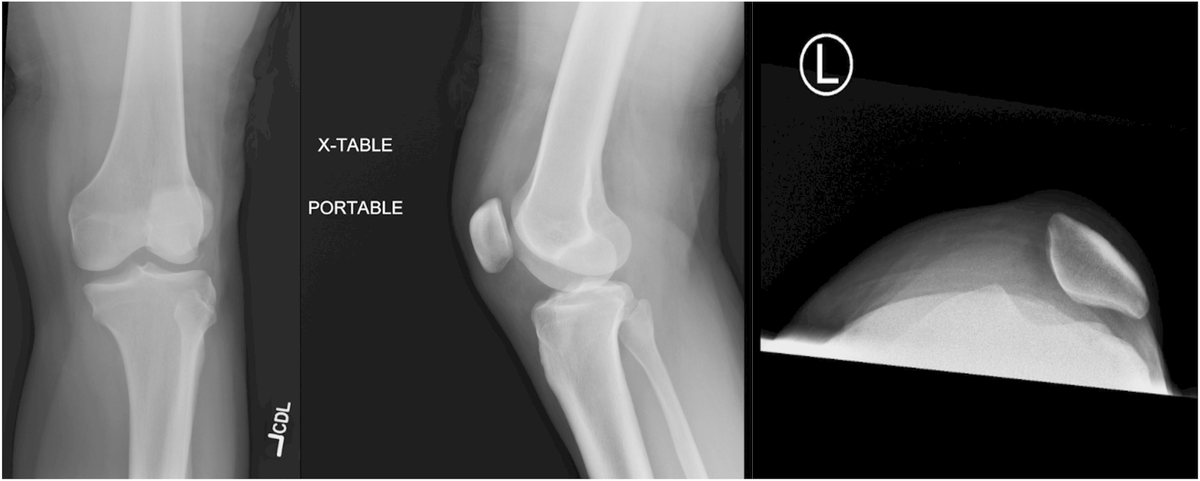 Lateral Meniscal Root Displacement into the Popliteal Hiatus in a Multiligamentous Knee Injury

tinyurl.com/2pwcrew3