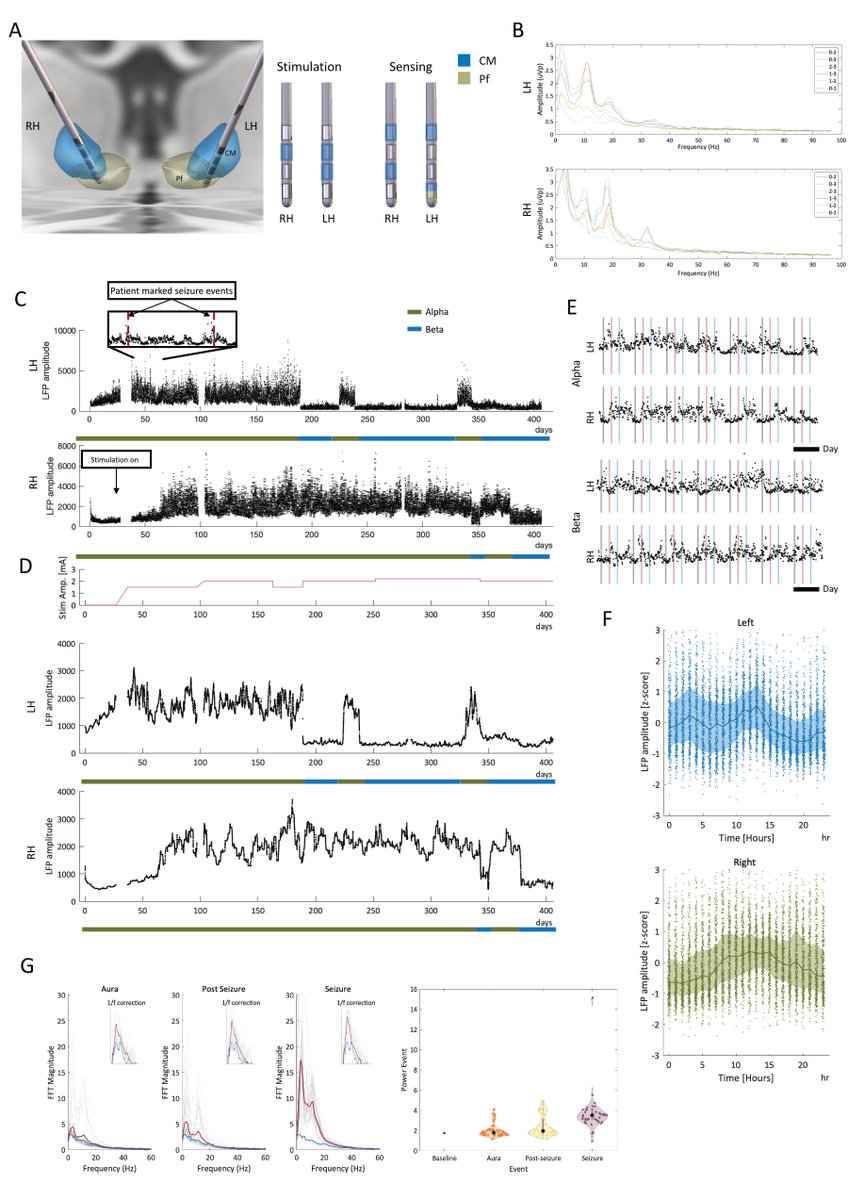 Initial case series of a novel sensing deep brain stimulation device in drug-resistant #epilepsy and consistent identification of alpha/beta oscillatory activity: A feasibility study
doi.org/10.1111/epi.17…

#epilepsy #DBS #drugresistant #ILAE <a href="/IlaeWeb/">International League Against Epilepsy</a> @epilepsiajourn <a href="/WileyNeuro/">Wiley Neuro</a>