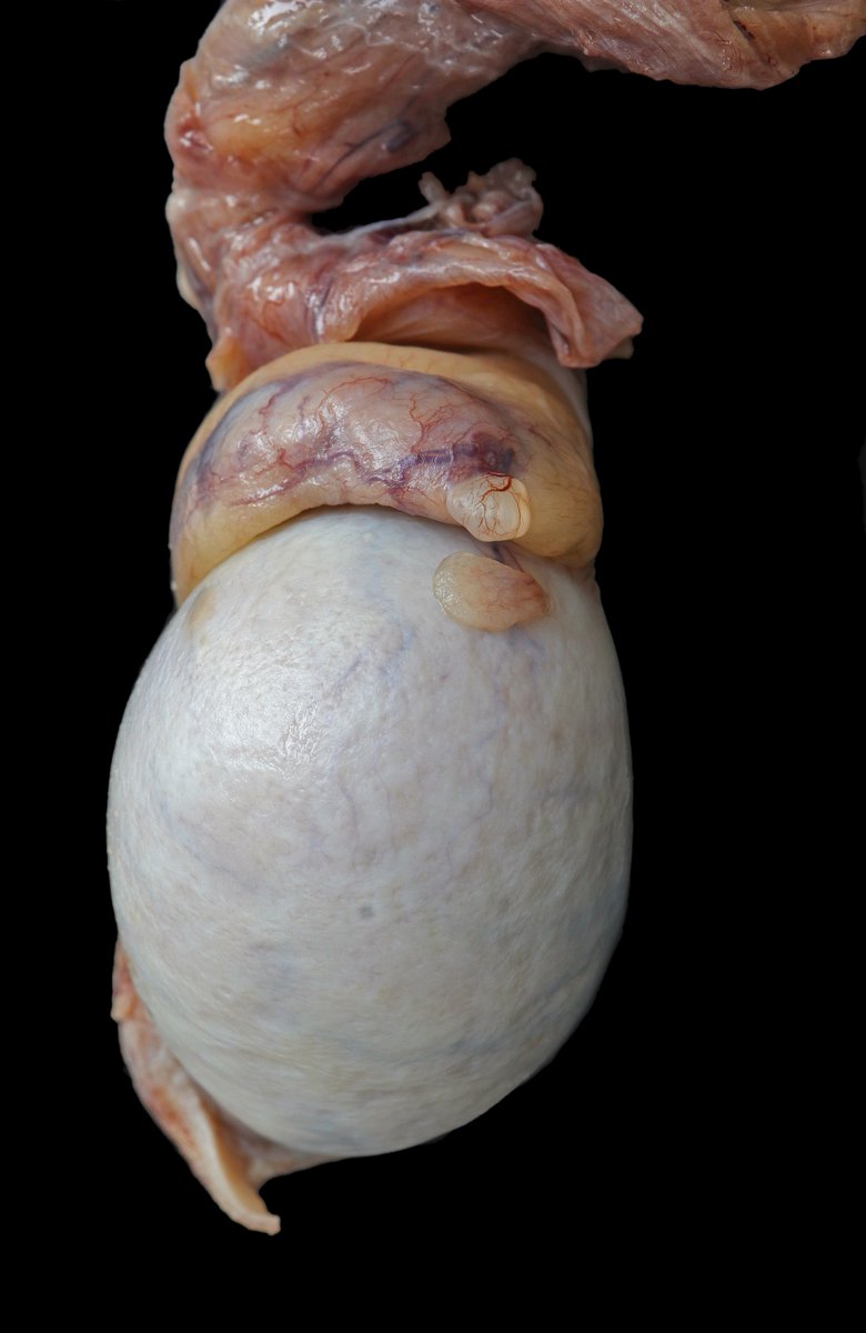 Andrew_Fltv's tweet image. Anatomy lesson by Dr. Morgagni.
Appendix testis (hydatids of Morgagni).
#GUpath #pathtwitter #anatomy #histology #pathoutpic